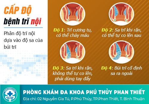 Nguyên nhân gây nên bệnh trĩ nội