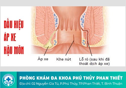 Dấu hiệu áp xe hậu môn như thế nào?
