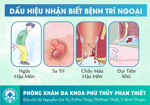 Bệnh trĩ ngoại có lây từ người thành sang người khác không?