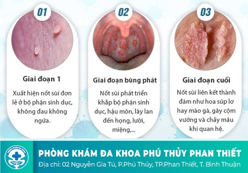 Biểu hiện sùi mào gà ở nữ như thế nào?