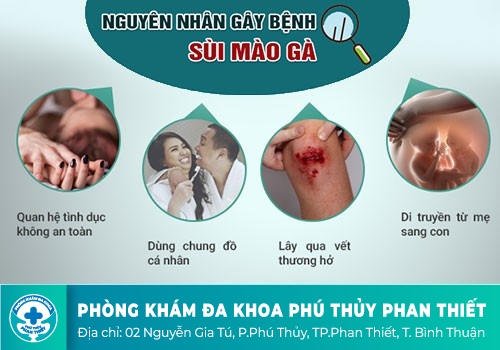 Nguyên nhân gây bệnh sùi mào gà là gì?