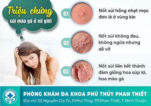 Triệu chứng của bệnh sùi mào gà nữ
