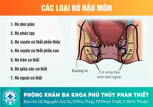 ĐAU RÁT HẬU MÔN CÓ THỂ MẮC BỆNH GÌ?