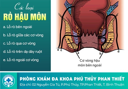 Triệu chứng nhận biết bệnh rò hậu môn