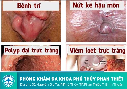Nứt hậu môn, rách hậu môn - dấu hiệu của nhiều bệnh lý