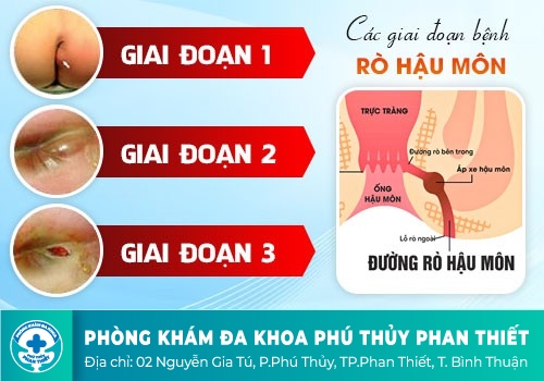 Áp xe hậu môn nguy hiểm như thế nào?