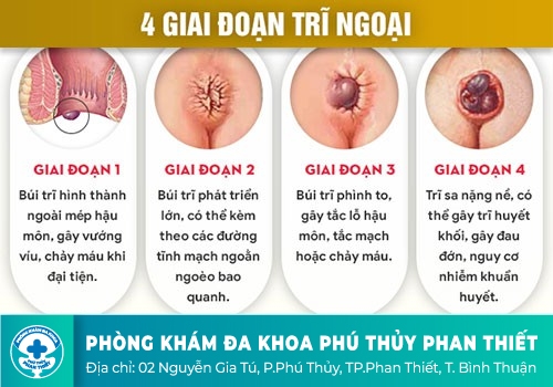 Biểu hiện của bệnh trĩ ngoại là gì?