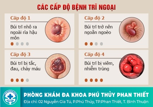 Nhận biết triệu chứng của bệnh trĩ ngoại qua từng cấp độ