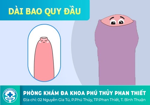 DẤU HIỆU VÀ BIỂU HIỆN CỦA DÀI BAO QUY ĐẦU