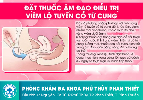 Giải pháp điều trị Viêm lộ tuyến cổ tử cung