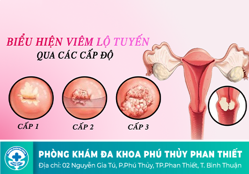 Giải pháp điều trị Viêm lộ tuyến cổ tử cung