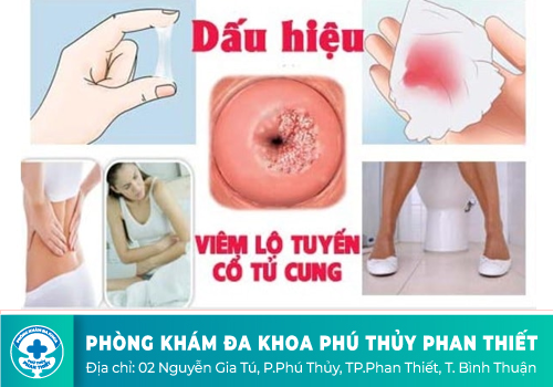 Viêm lộ tuyến tử cung