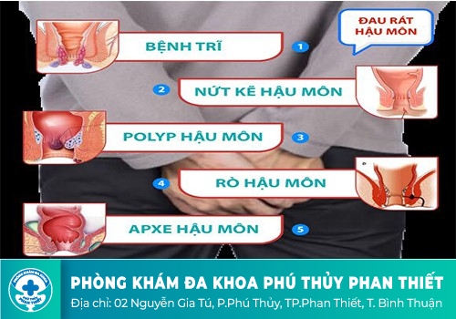 ĐAU HẬU MÔN, SƯNG HẬU MÔN DẤU HIỆU CỦA NHIỀU BỆNH NGUY HIỂM