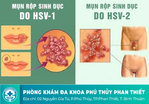 Nguyên nhân gây bệnh mụn rộp sinh dục là gì?