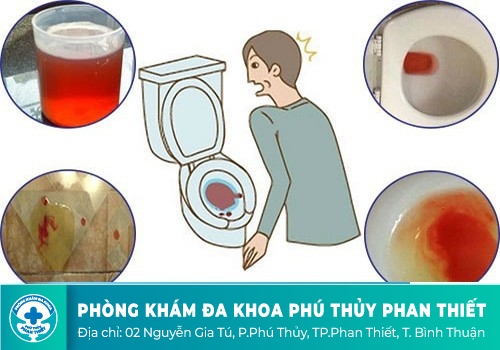 Tiểu ra máu là gì?