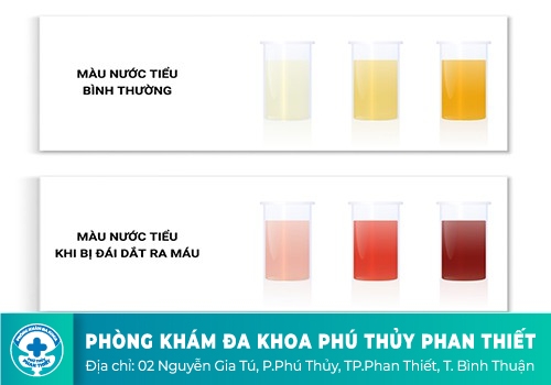 Tiểu Đau Tiểu Ra Máu Là Cảnh Báo Bệnh Gì?