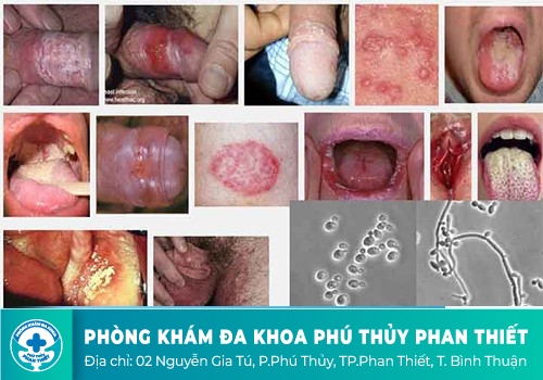 Hình ảnh nấm Candida ở nam giới và nữ giới