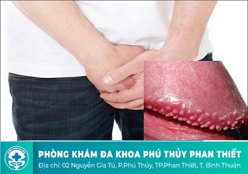 dương vật nổi mụn li ti