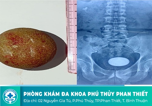 Đau bàng quang do sỏi bàng quang