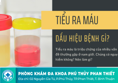 Triệu chứng nhận biết bệnh tiểu ra máu