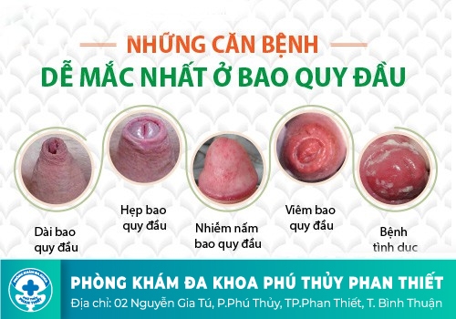 Vì đâu bao quy đầu không tự tuột được?