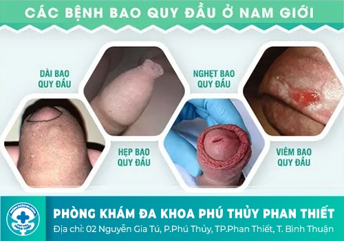 bệnh dương vật hay gặp ở nam giới