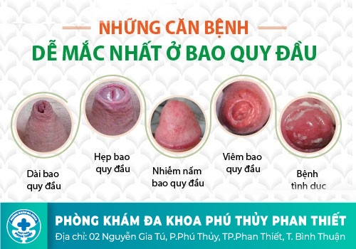 Dính bao quy đầu là gì?