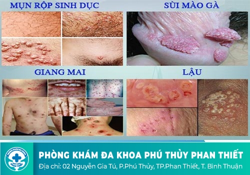 hình ảnh bệnh nam khoa