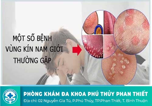 Nổi hạch ở vùng kín là bệnh gì