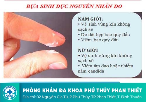Nguyên nhân gây nên bựa sinh dục