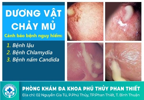  Chảy mủ ở dương vật và sốt cao, đùng vùng hố lưng 1 hoặc 2 bên