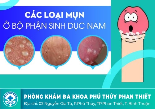 Tinh hoàn nổi mụn gồm những loại nào?