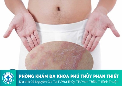 NỔI MẨN ĐỎ QUANH BAO QUY ĐẦU LÀ DẤU HIỆU CỦA BỆNH GÌ?