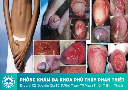 Một số hình ảnh về bệnh nguy hiểm ở lỗ sáo và dấu hiệu nhận biết