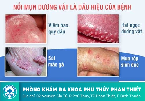 Nổi Mụn Dương Vật Là Triệu Chứng Bệnh Gì?