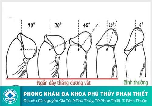 NHỮNG TÁC HẠI CỦA VIỆC ĐỨT DÂY HÃM BAO QUY ĐẦU