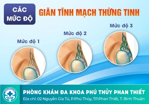 Giãn tĩnh mạch thừng tinh