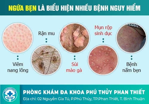 Nguyên nhân gây ngứa bộ phận sinh dục ở quý ông
