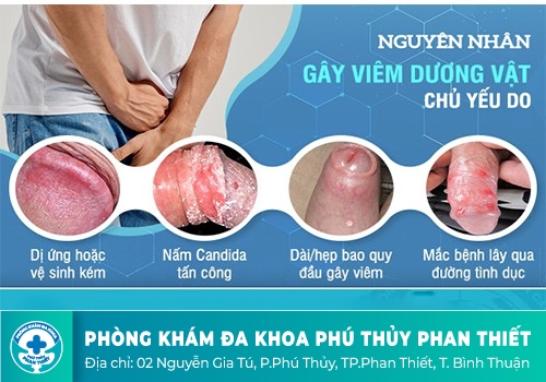 1 số hình ảnh dấu hiệu bệnh viêm dương vật ở nam giới?