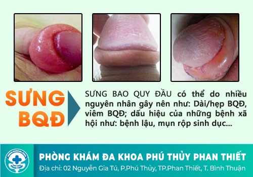 NAM GIỚI CẦN CẢNH GIÁC VỚI TÌNH TRẠNG SƯNG BAO QUY ĐẦU