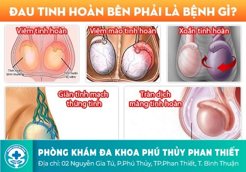 nguyên nhân gây ra những cơn đau tại tinh hoàn phải