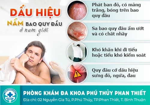 Khi dương vật có nhiều bựa trắng có mùi hôi là dấu hiệu của bệnh gì?