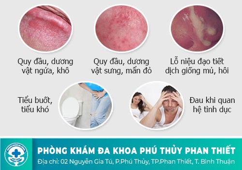 Bệnh nấm vùng bìu do nấm Candida