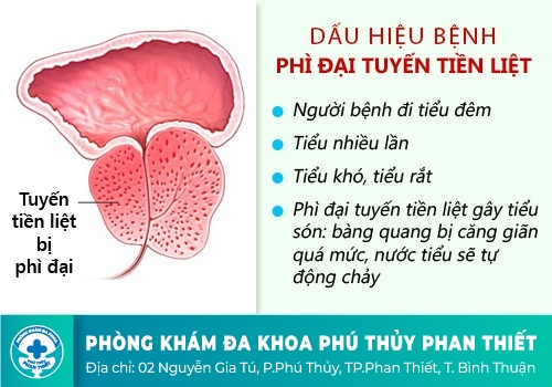 Phì đại tuyến tiền liệt