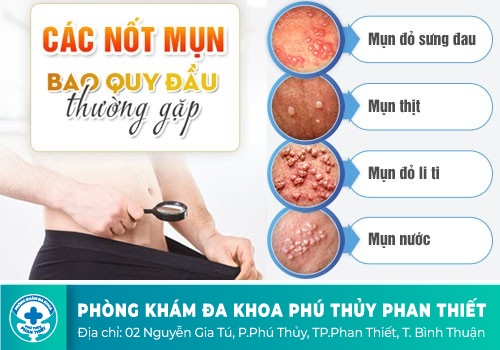 Viêm bao quy đầu (Ở nam)