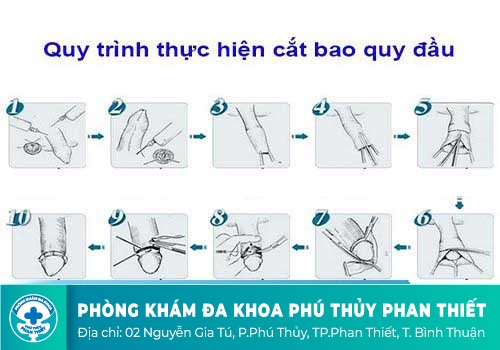 Quy trình cắt bao quy đầu diễn ra thế nào?