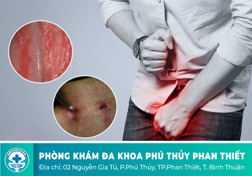 Vì sao nam giới bị sưng bao quy đầu sau khi quan hệ