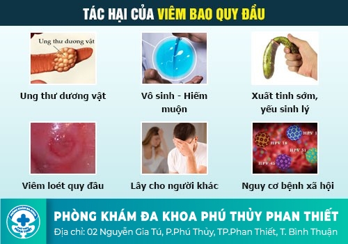 Bạn đã biết hết những nguy hiểm của viêm bao quy đầu hay chưa?