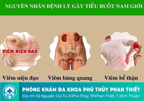 Biểu hiện của bệnh tiểu buốt ở nam giới