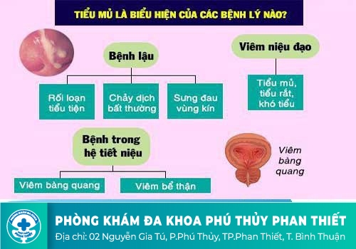 Tiểu ra mủ - dấu hiệu của các bệnh nam khoa khác ngoài bệnh lậu